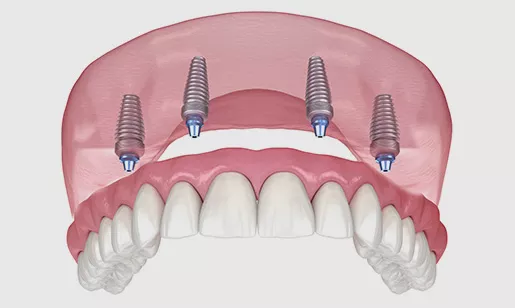 Denture Fixed Grey