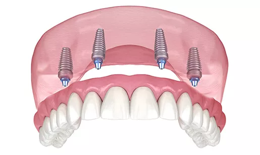 Implant Fixed