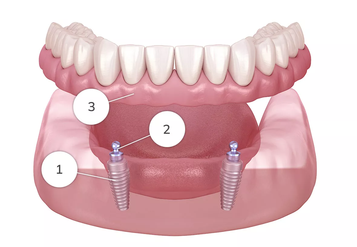 Implant Supported Denture